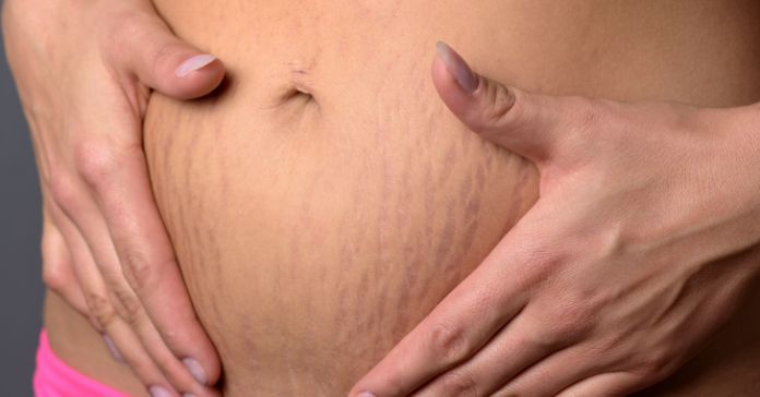 Common Misconceptions About Pregnancy Stretch Marks